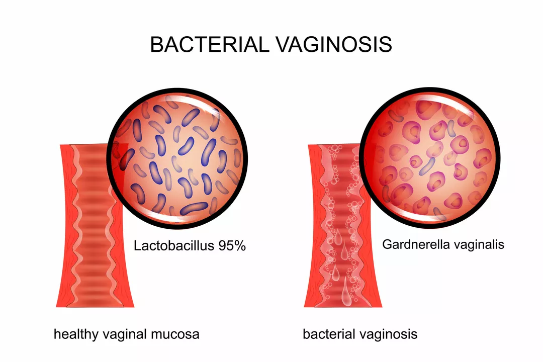 The Connection Between Bacterial Vaginosis and Sexual Health
