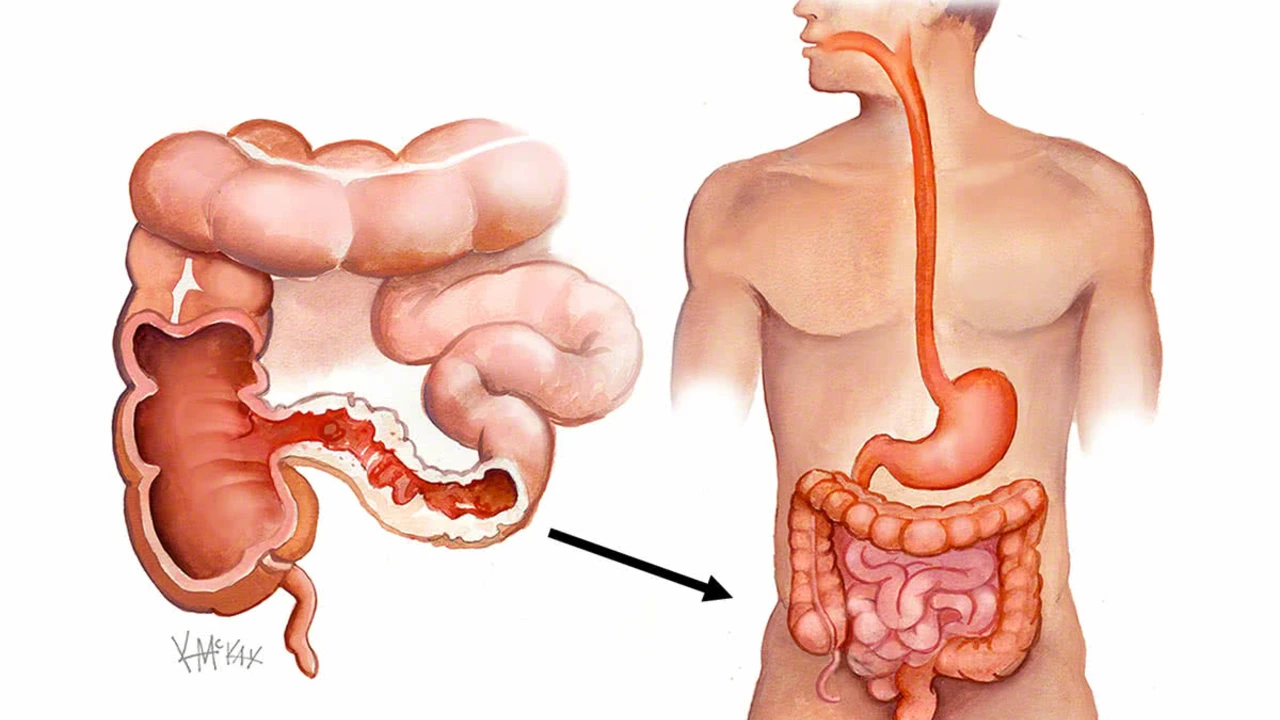 Diarrhea and Crohn's Disease: Living with a Chronic Condition