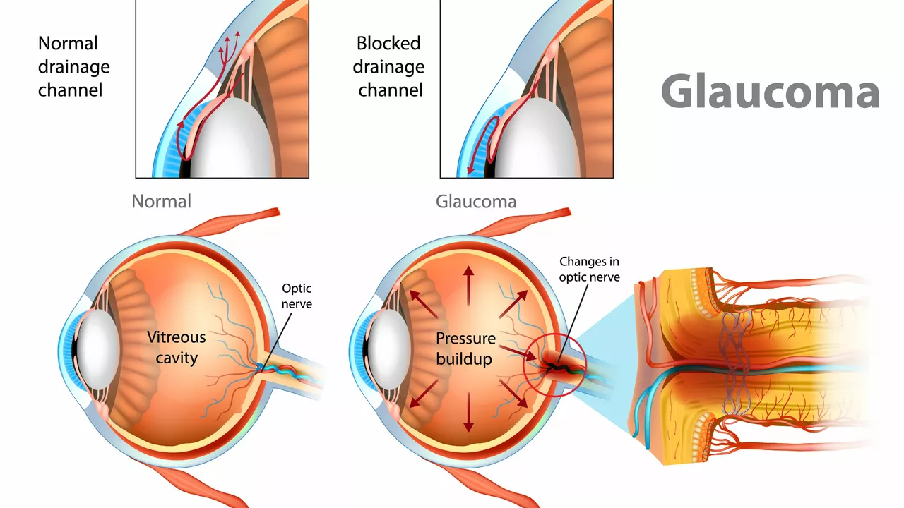 The Connection Between Diabetes and Open-Angle Glaucoma: What You Should Know